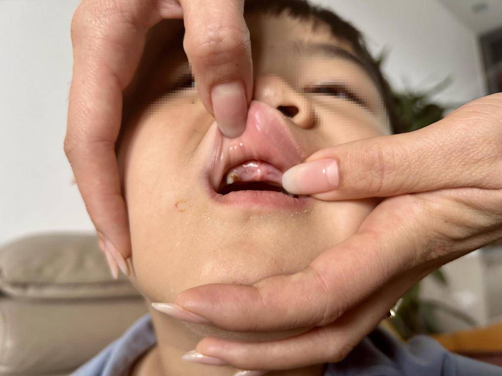 6岁孩子幼儿园摔断恒牙！54天，夫妻二人为一颗牙维权